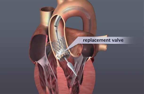 HEART VALVE REPAIR OR REPLACEMENT SURGERY Best Medical Care Service