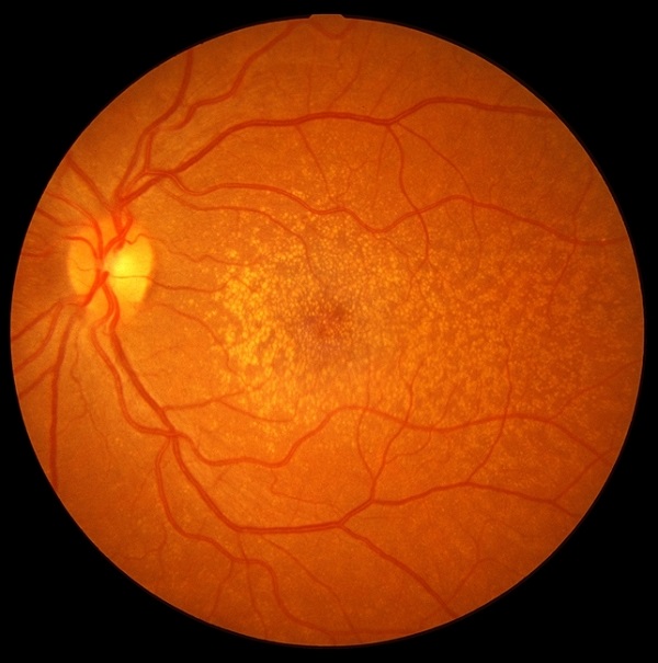AGERELATED MACULAR DEGENERATION Best Medical Care Service, Medical