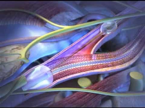 CAROTID ANGIOPLASTY AND STENTING visual data 5