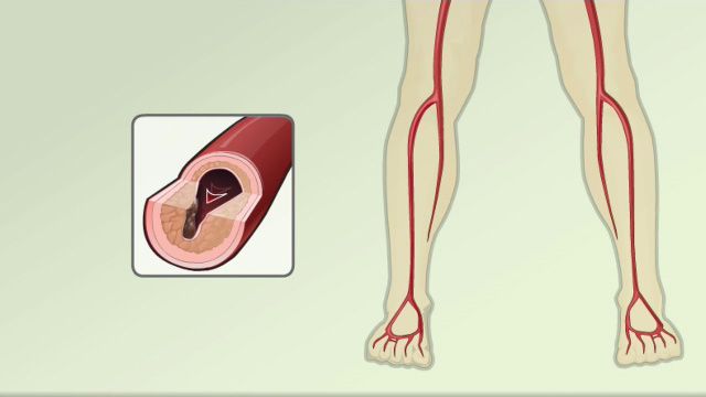 femoral-popliteal-bypass-surgery-best-medical-care-service-medical