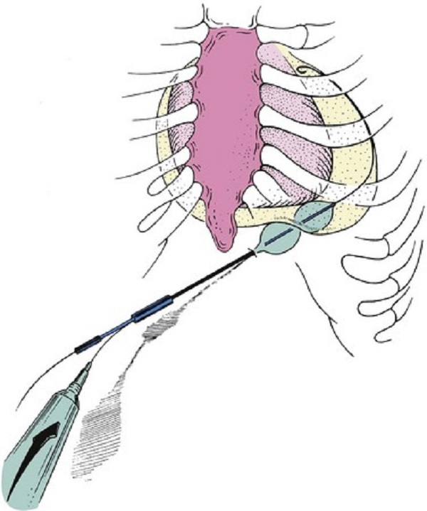 PERCUTANEOUS BALLOON PERICARDIOTOMY - Best Medical Care Service ...