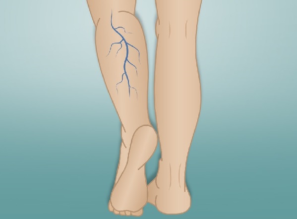 Varicose Veins (Spider Veins) - Best Medical Care Service, Medical ...